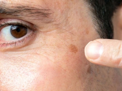 Tired of Age Spots? Try These Natural Solutions Today